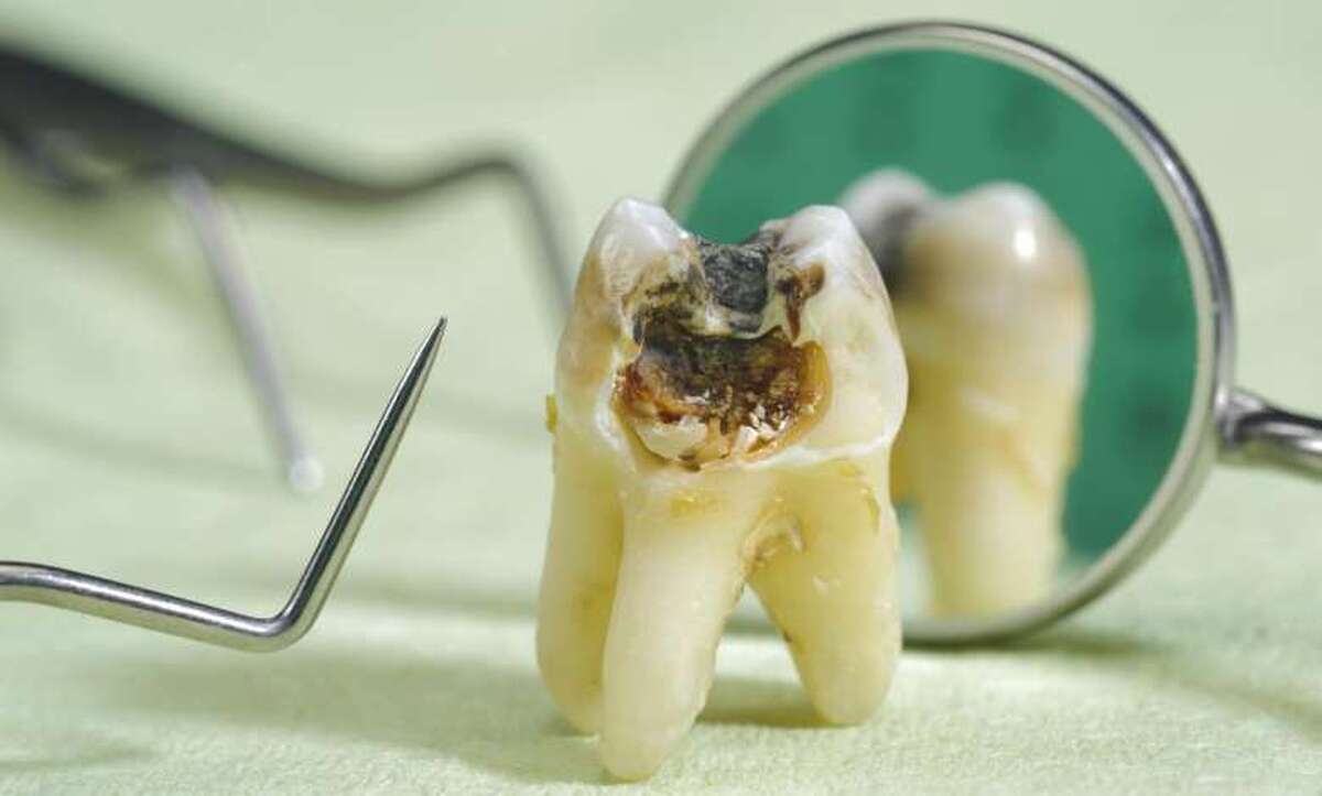 پیشگیری از پوسیدگی دندان با “کامپوزیت دندانی” ایران‌ساخت