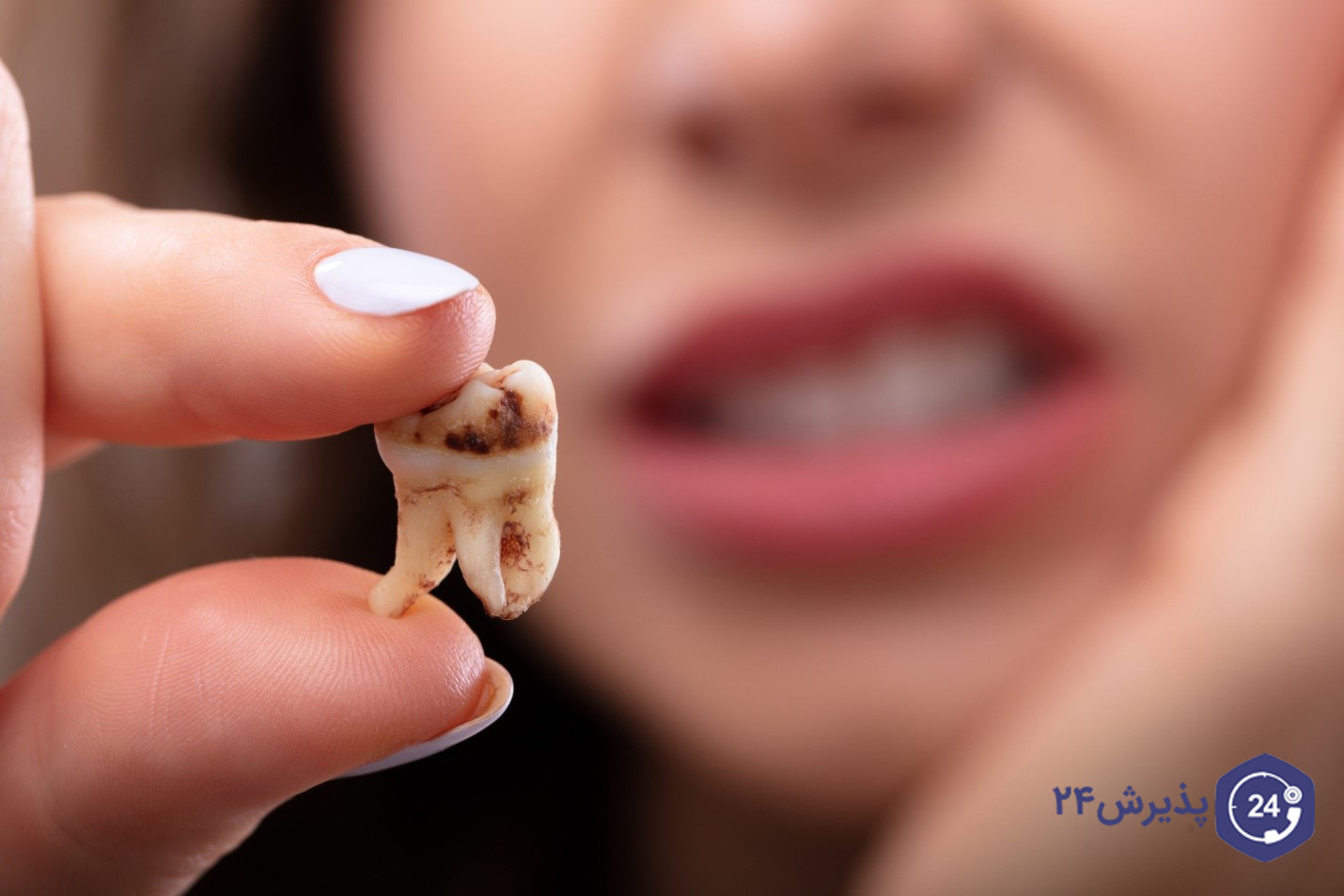 بیماری‌های خطرناکی که با پوسیدگی دندان به سراغتان می‌آید
